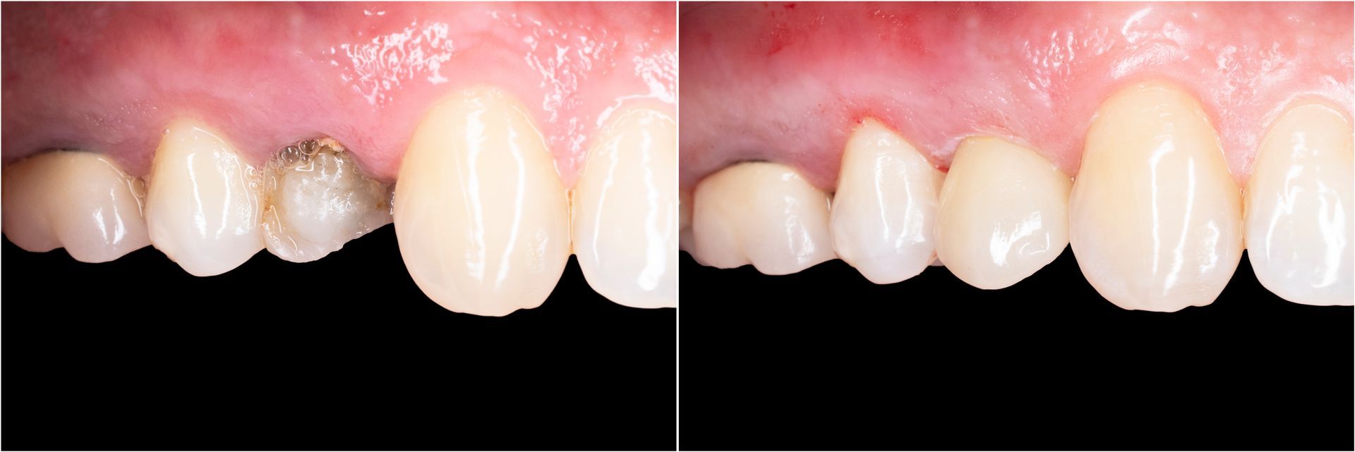 dental crown in Attleboro, MA
