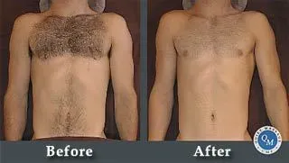 manscaping beforemanscaping chest and arms, before & after and after