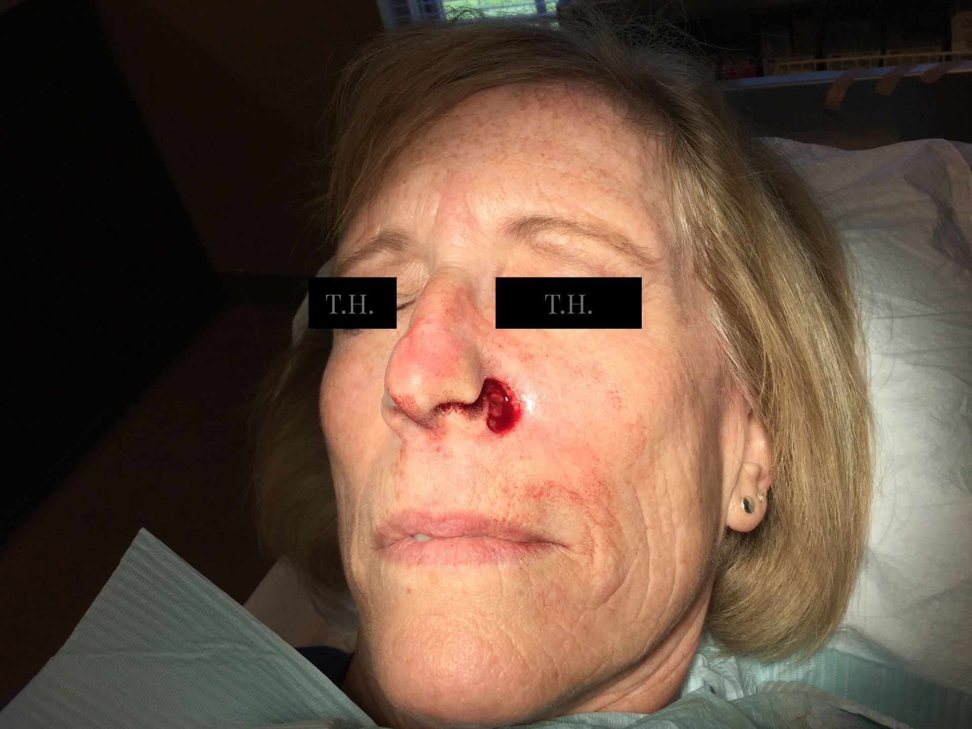 Before, sutured, and follow up photos of a cheek surgery