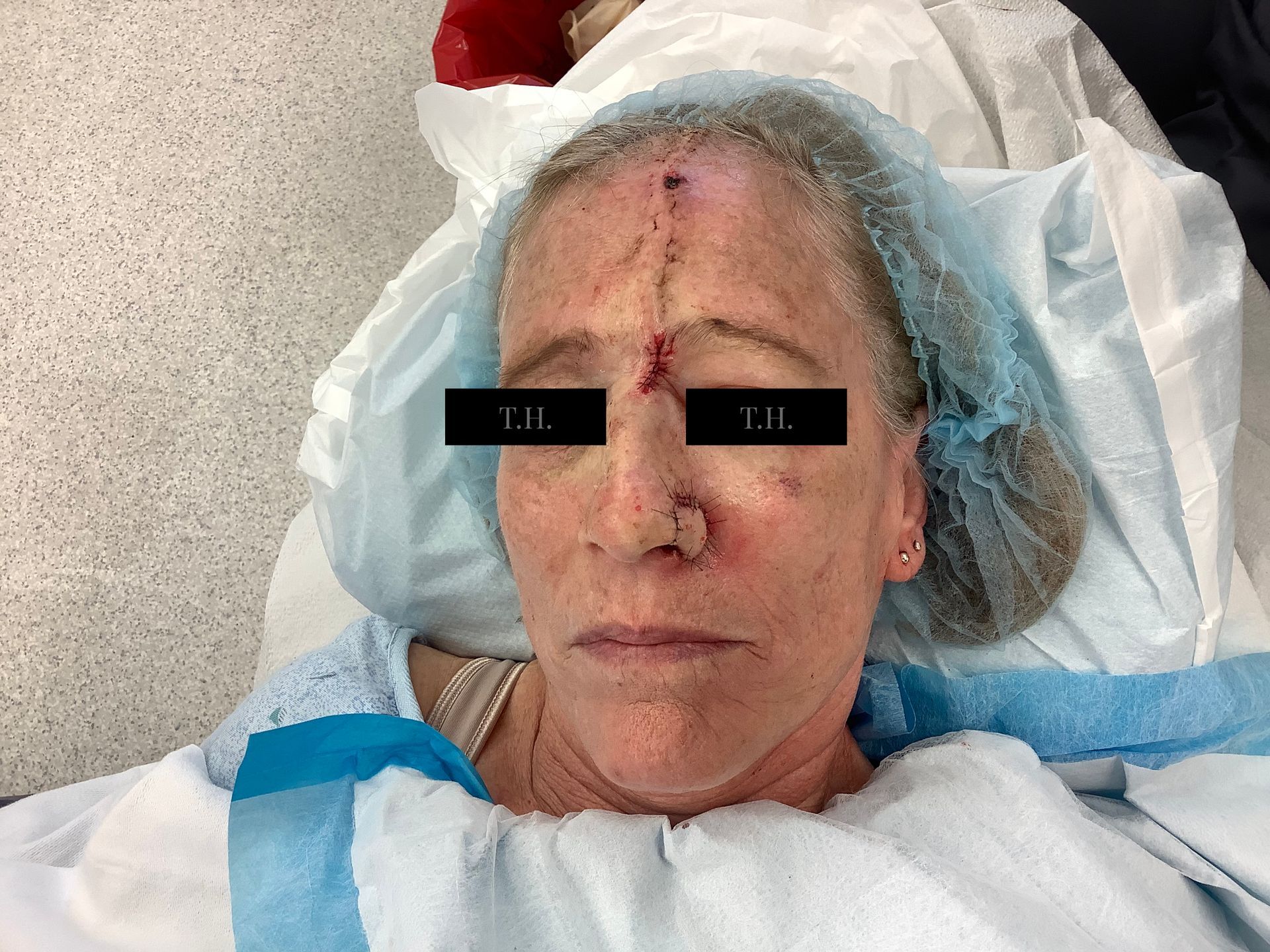 Close up of a woman's face who just underwent surgery