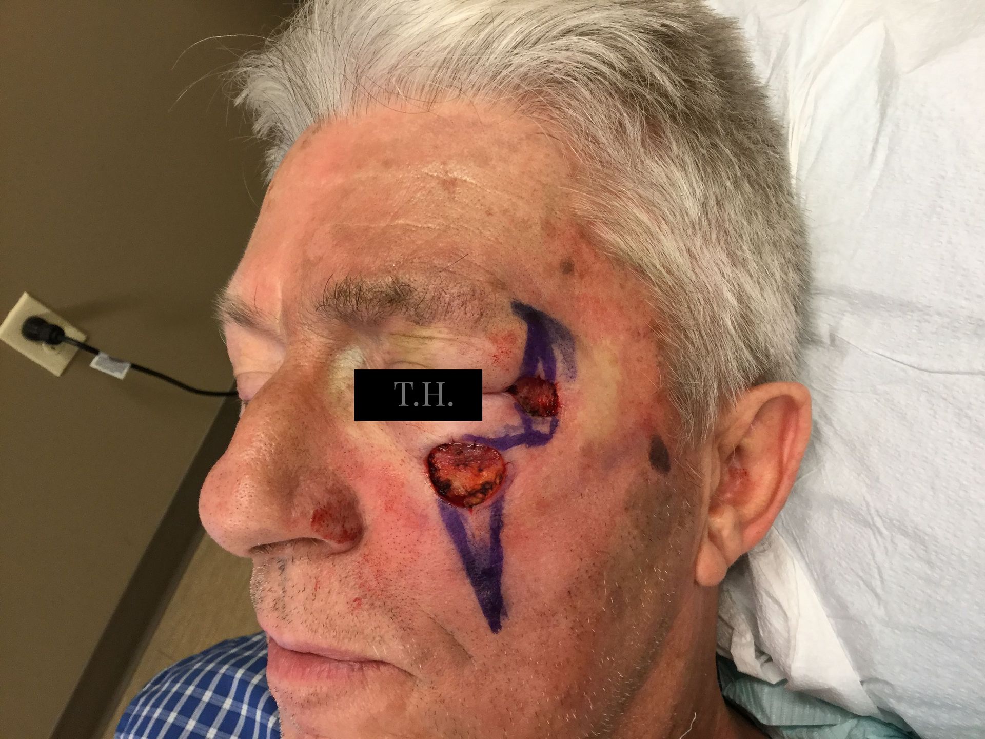 A close up of a mohs surgery wound