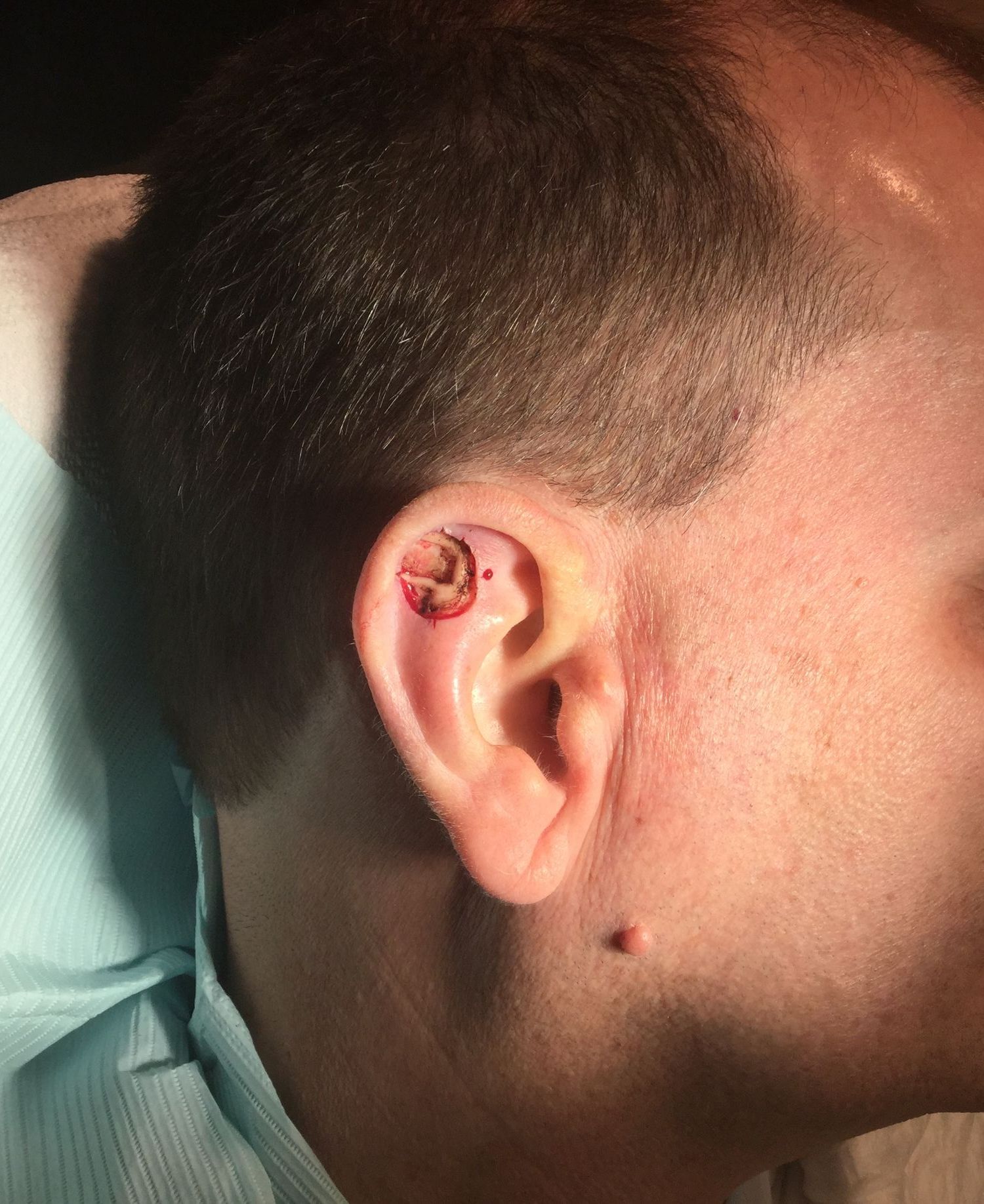 A close up of a man 's ear with a wound on it