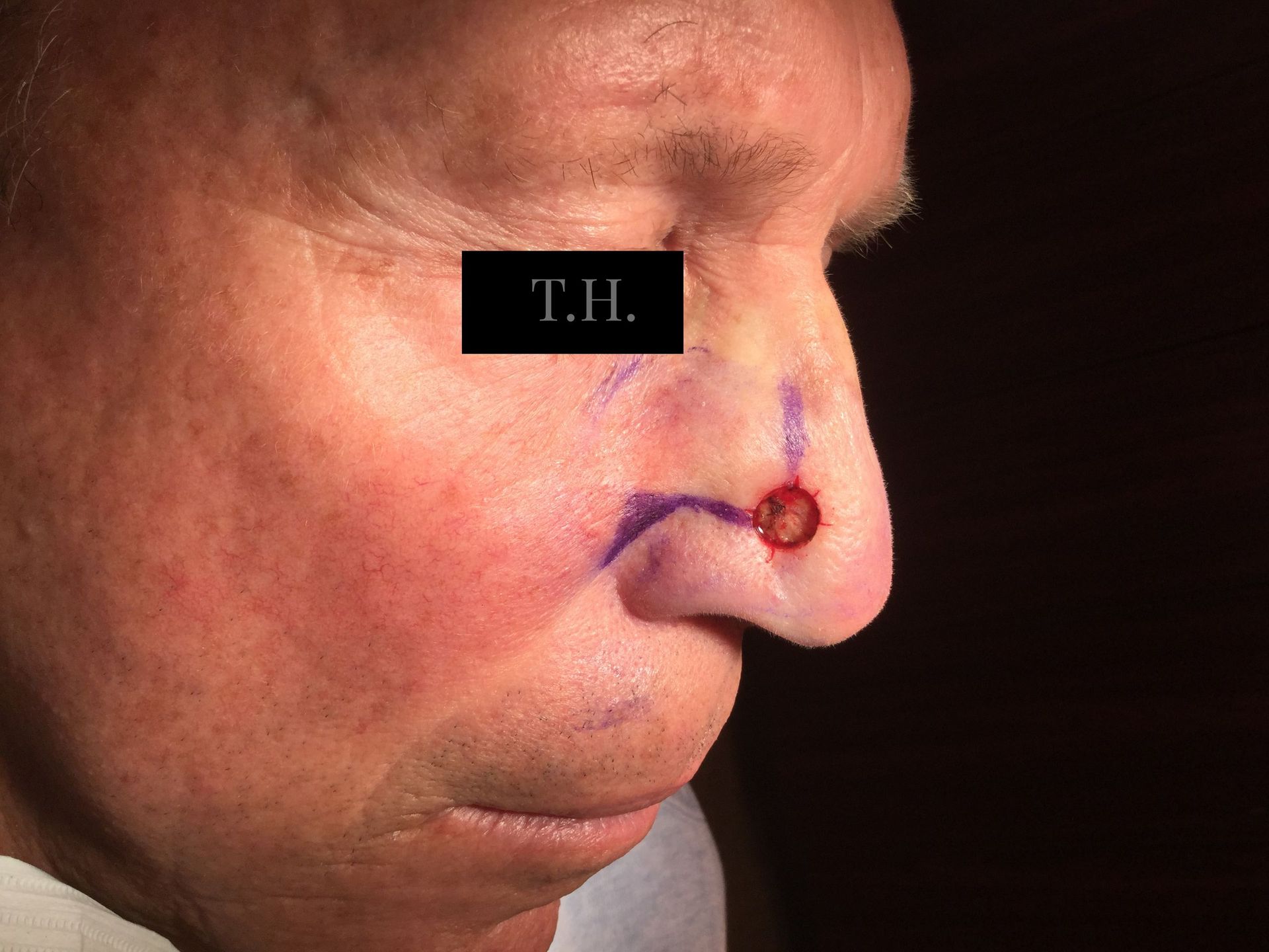 Before, sutured, and follow up photos of a nose surgery