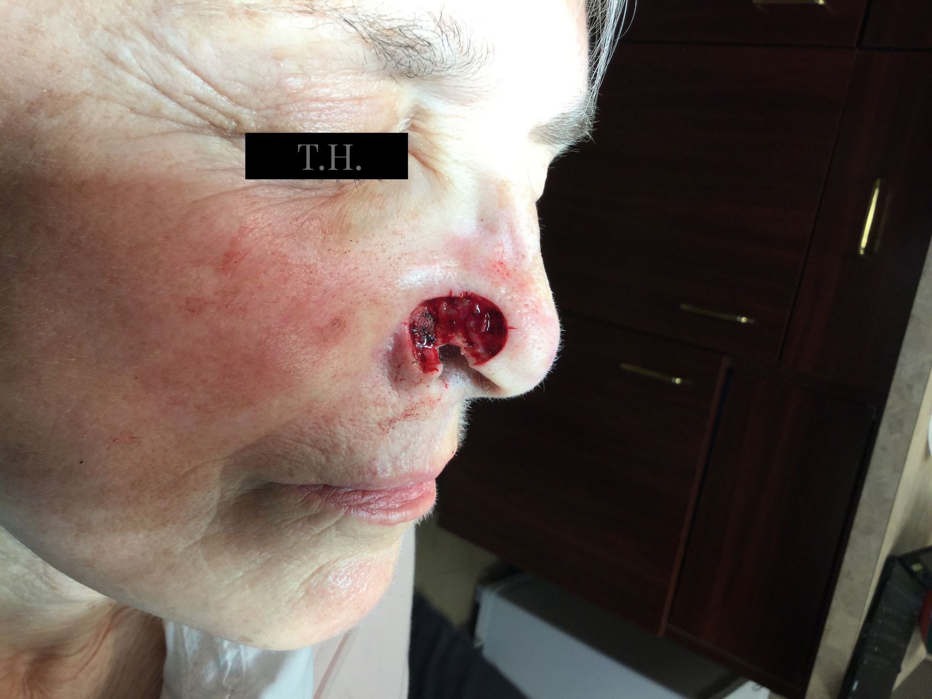 A close up of a mohs surgery wound