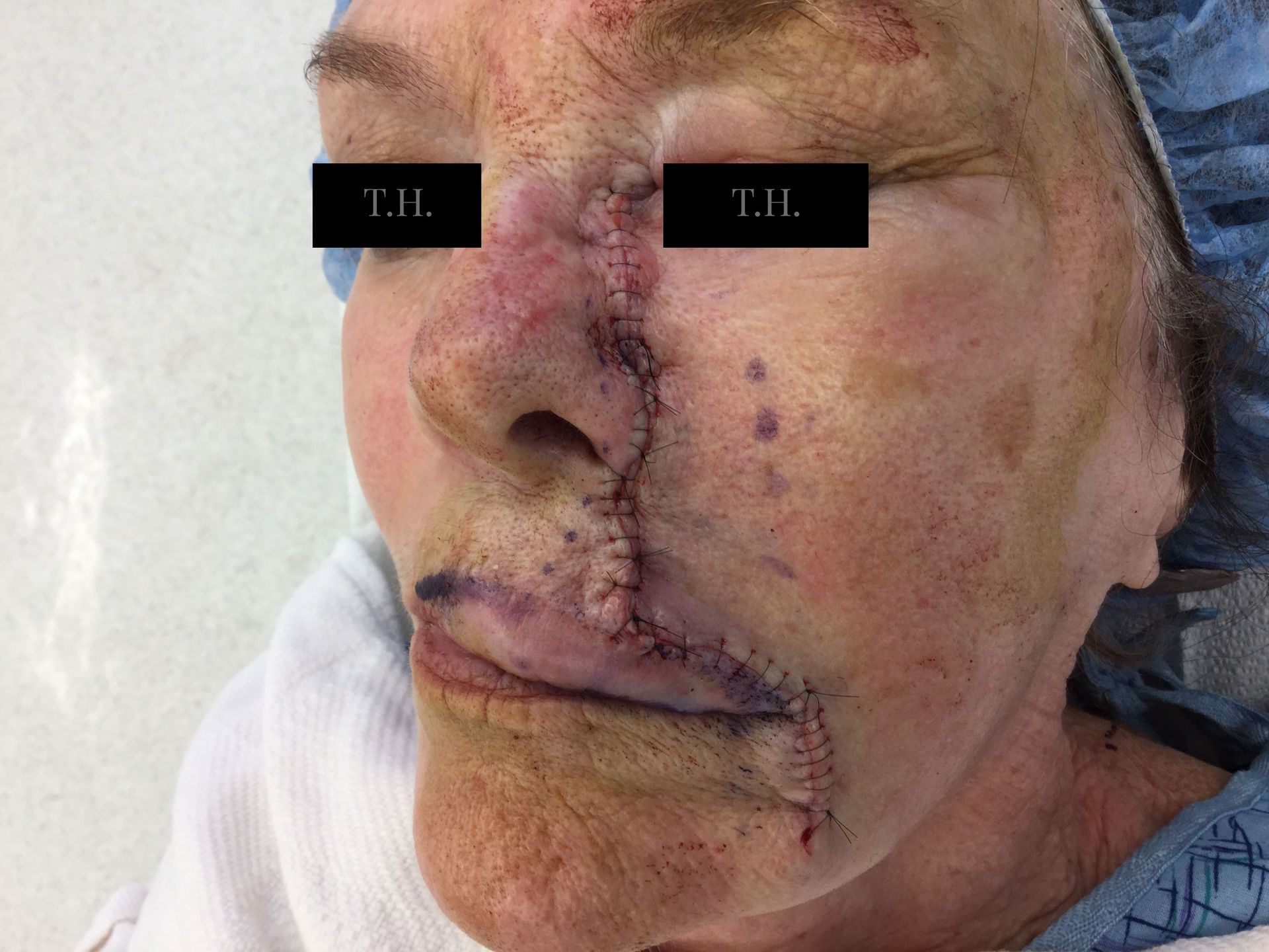 A close up of a mohs surgery scar