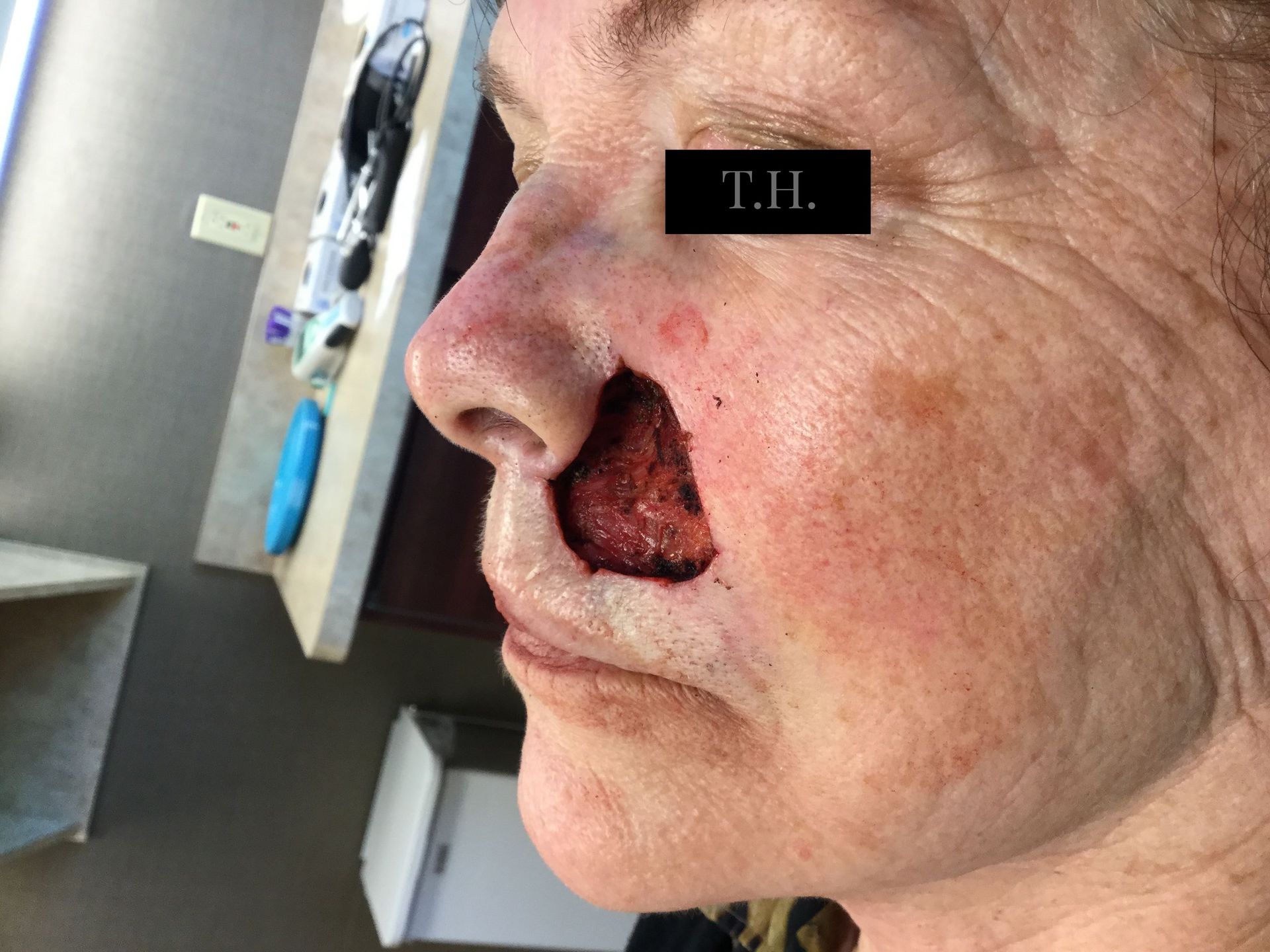 A close up of a mohs surgery wound