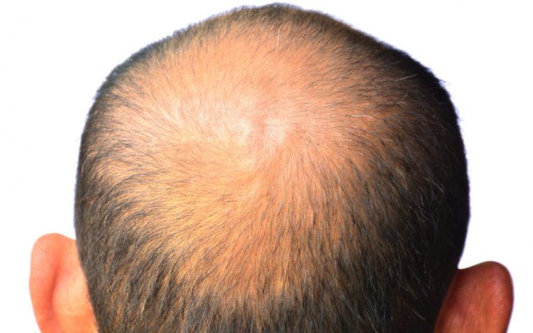 The back of a man 's head with a bald spot.