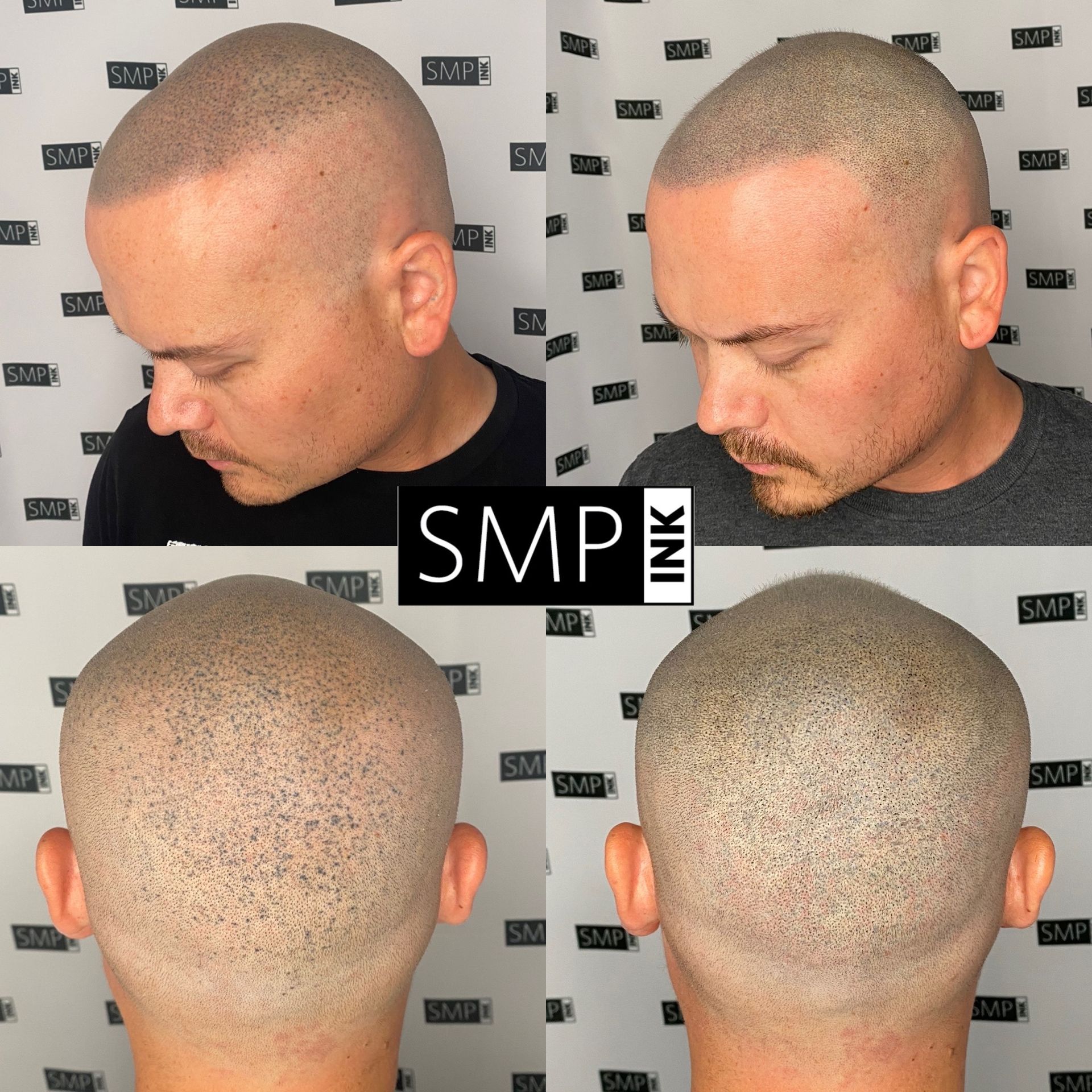 Results of SMP touch up treatment