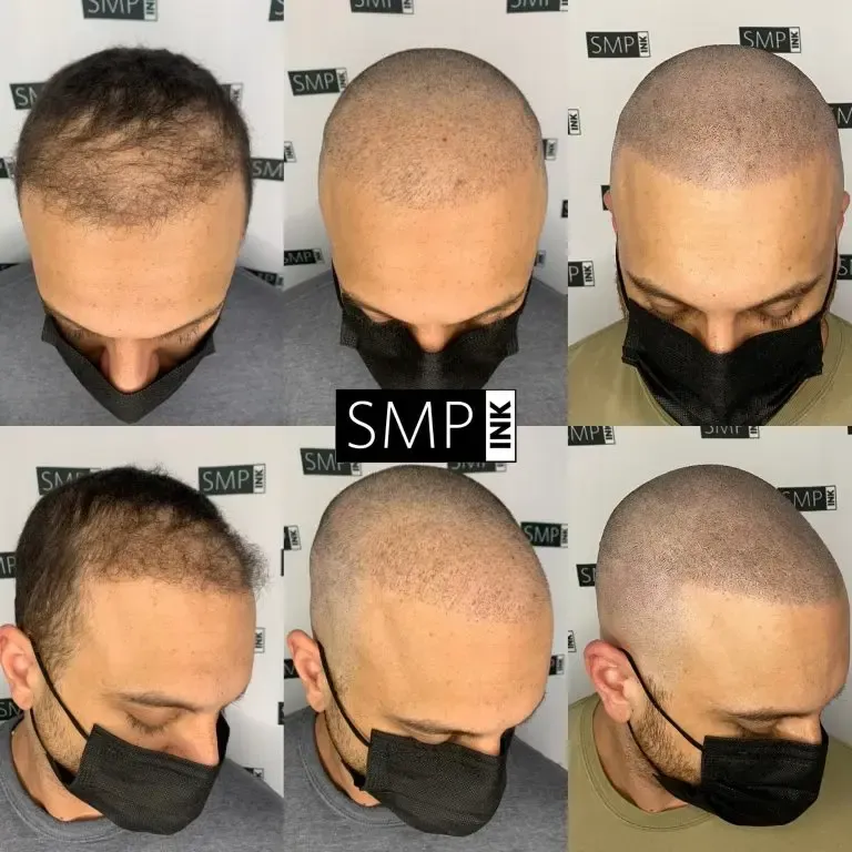 before and after receiving SMP from SMP INK