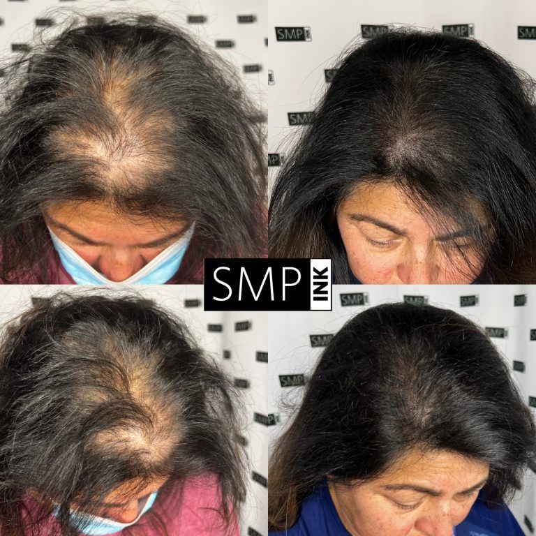 A collage of four pictures of a woman 's hair before and after SMP INK treatment