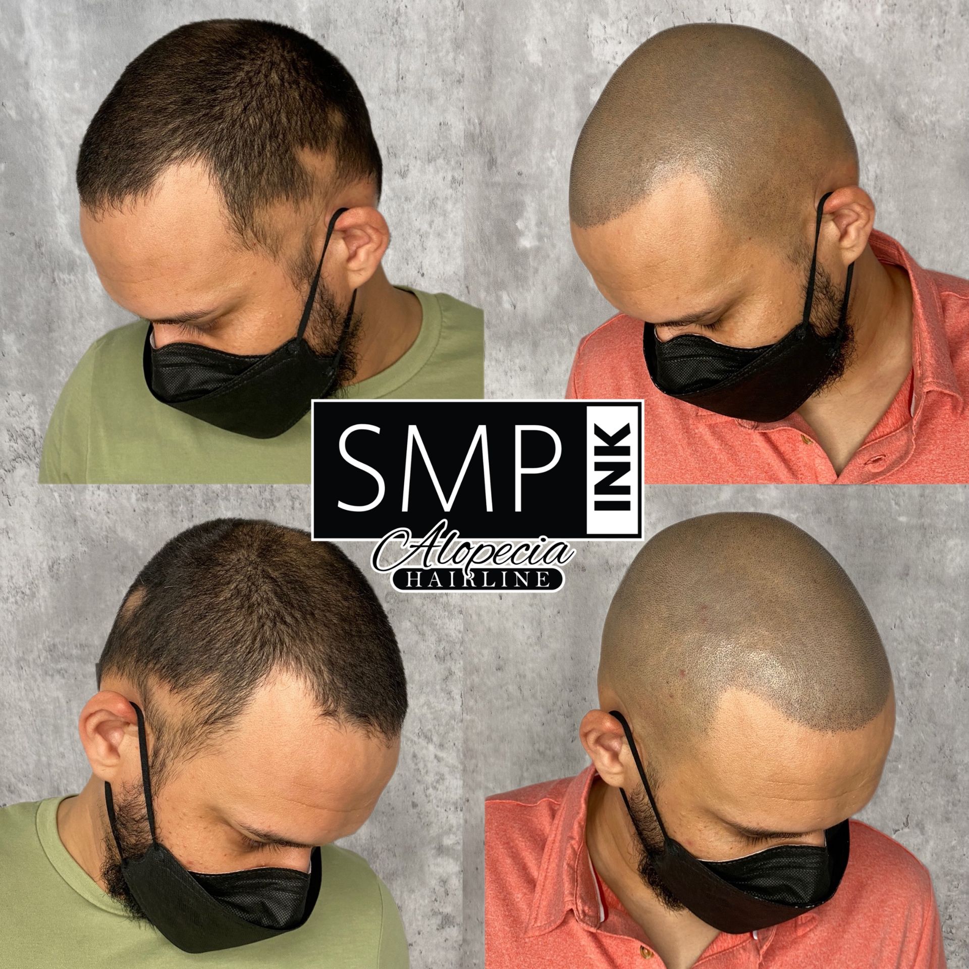 example of successful Alopecia Treatment utilizing Scalp micropigmentatiion