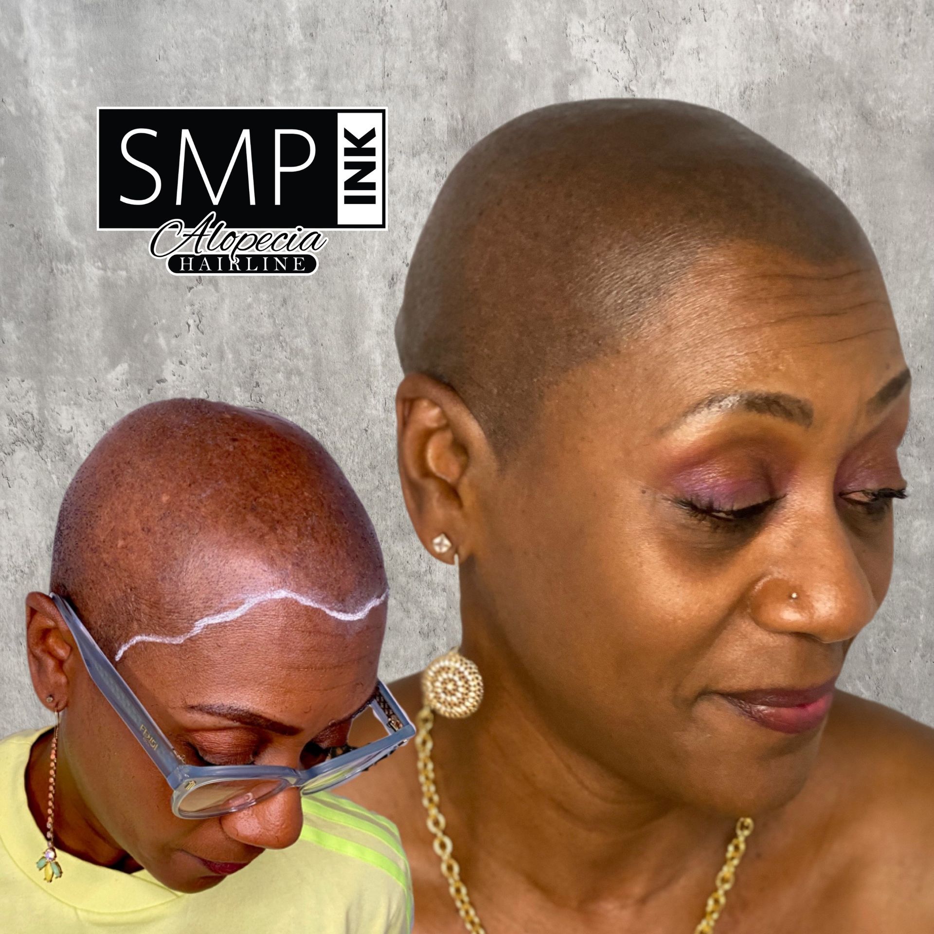 Cilent results of Alopecia Treatment utilizing SMP