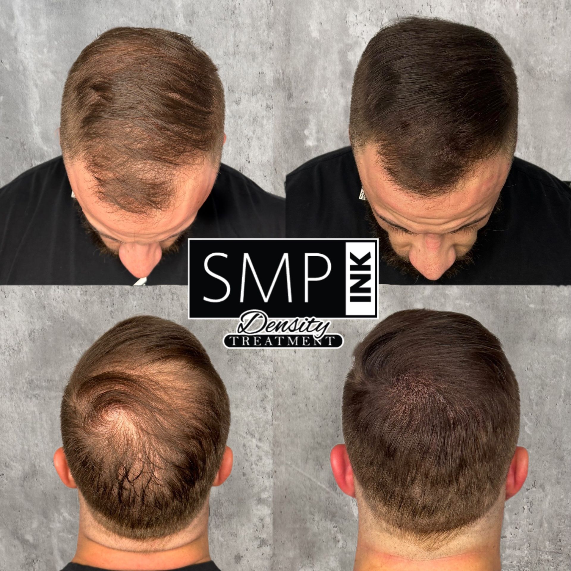 Scalp Micropigmentation | SMP INK | Las Vegas