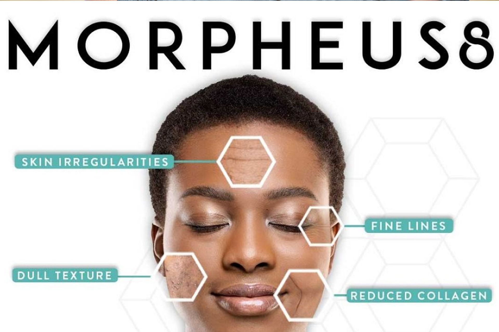 Morpheus 8 skin tightening (face and body)