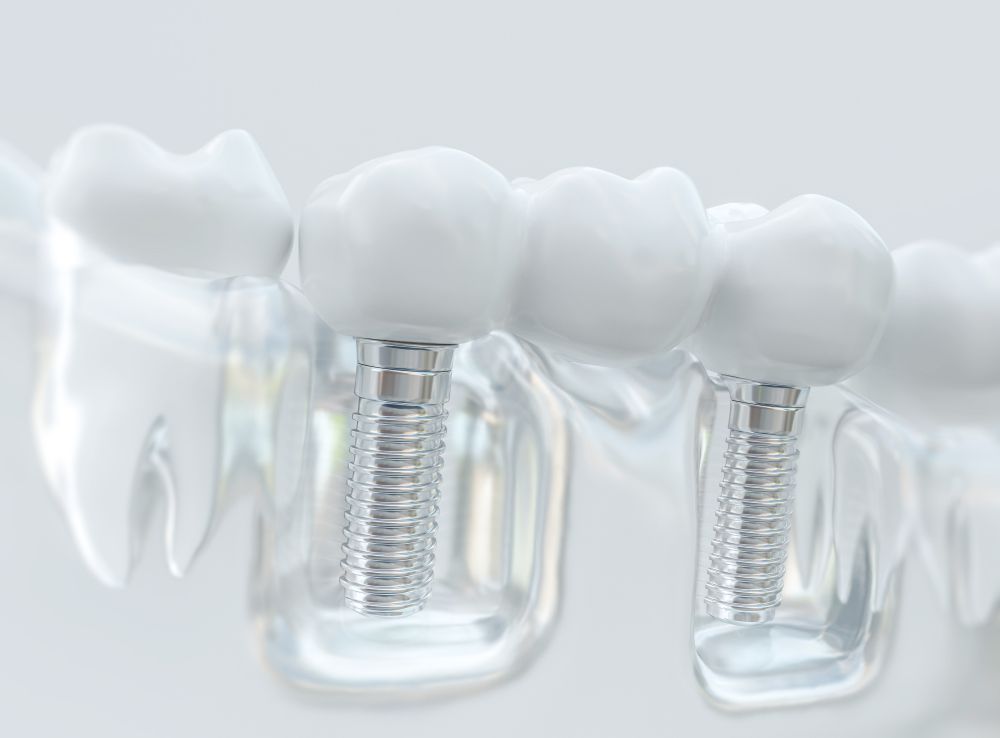A 3d rendering of a dental bridge with dental implants.