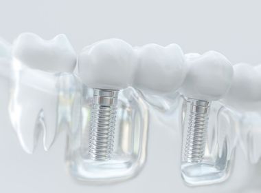 A 3d rendering of a dental bridge with dental implants.