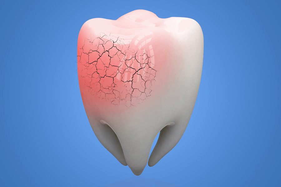 Damaged Tooth — Orange, CT — New England Dental Health Services PC