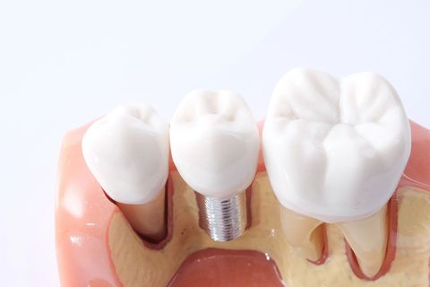 Impianti dentali e corone in un primo piano di gengive e denti