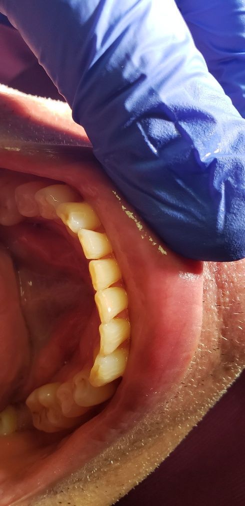 After Treatment for Lower Teeth — The Villages, FL — Central Florida Dental