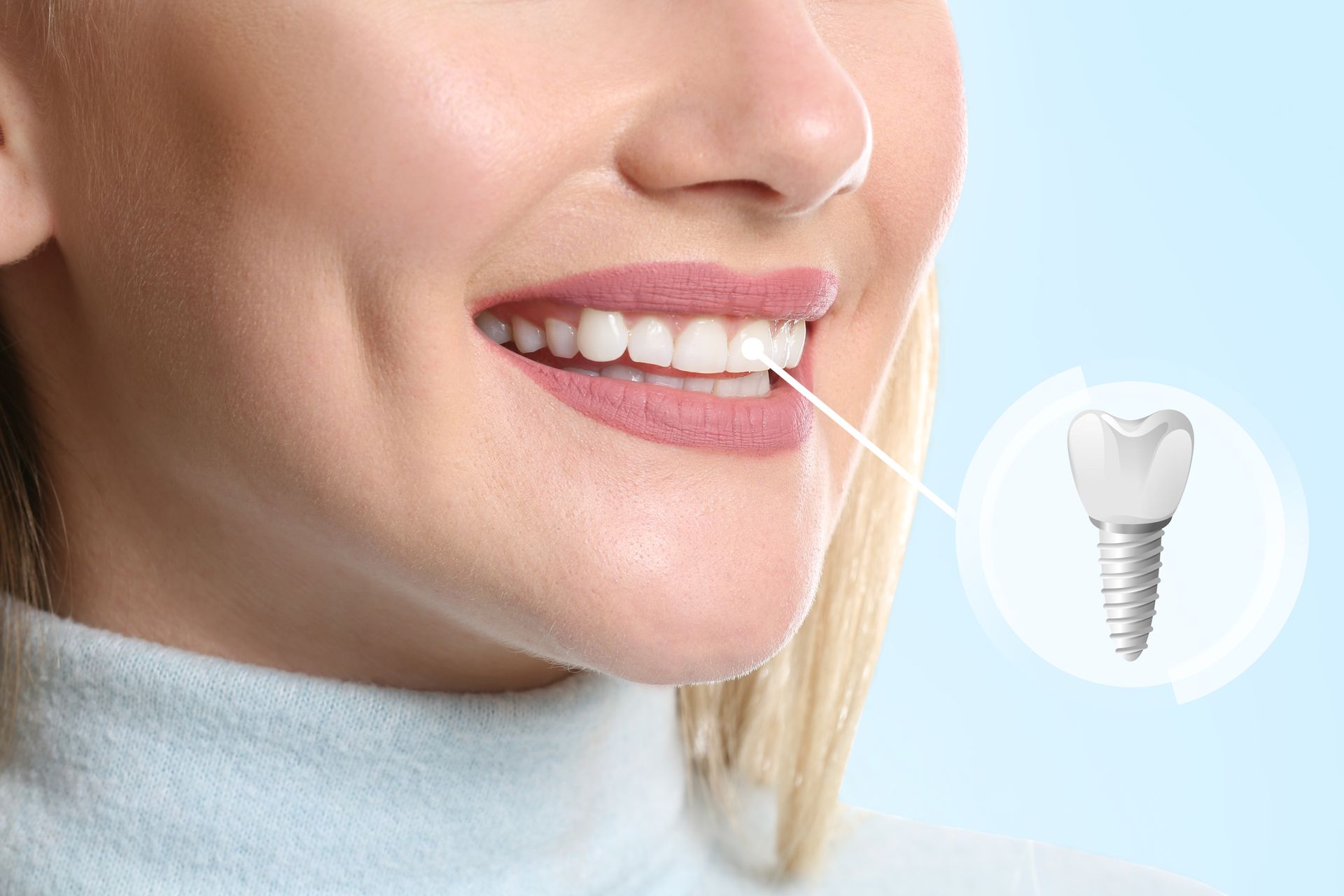 Close-up of a healthy white smile highlighting a titanium dental implant solution. Close-up of a healthy white smile highlighting a titanium dental implant solution.