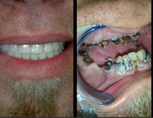 Before and after Mt. Dora — The Villages, FL — Central Florida Dental