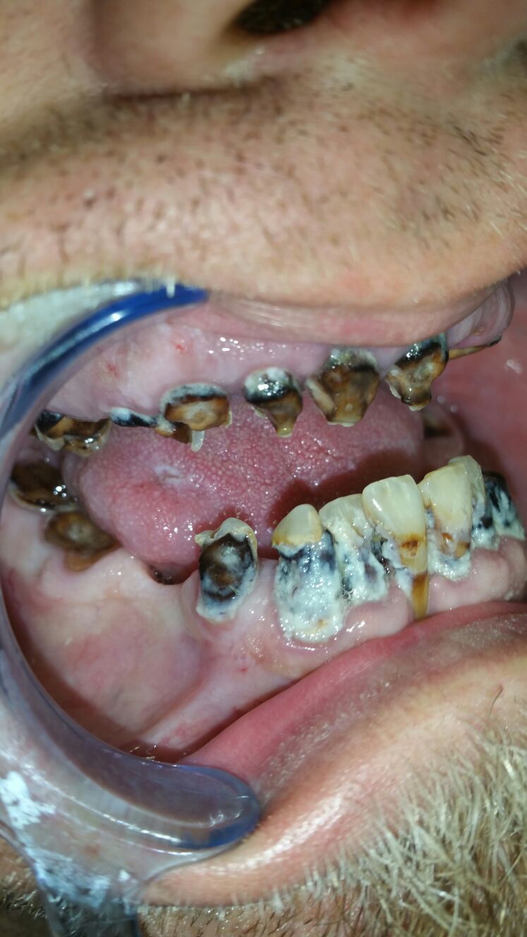Denture Before — The Villages, FL — Central Florida Dental