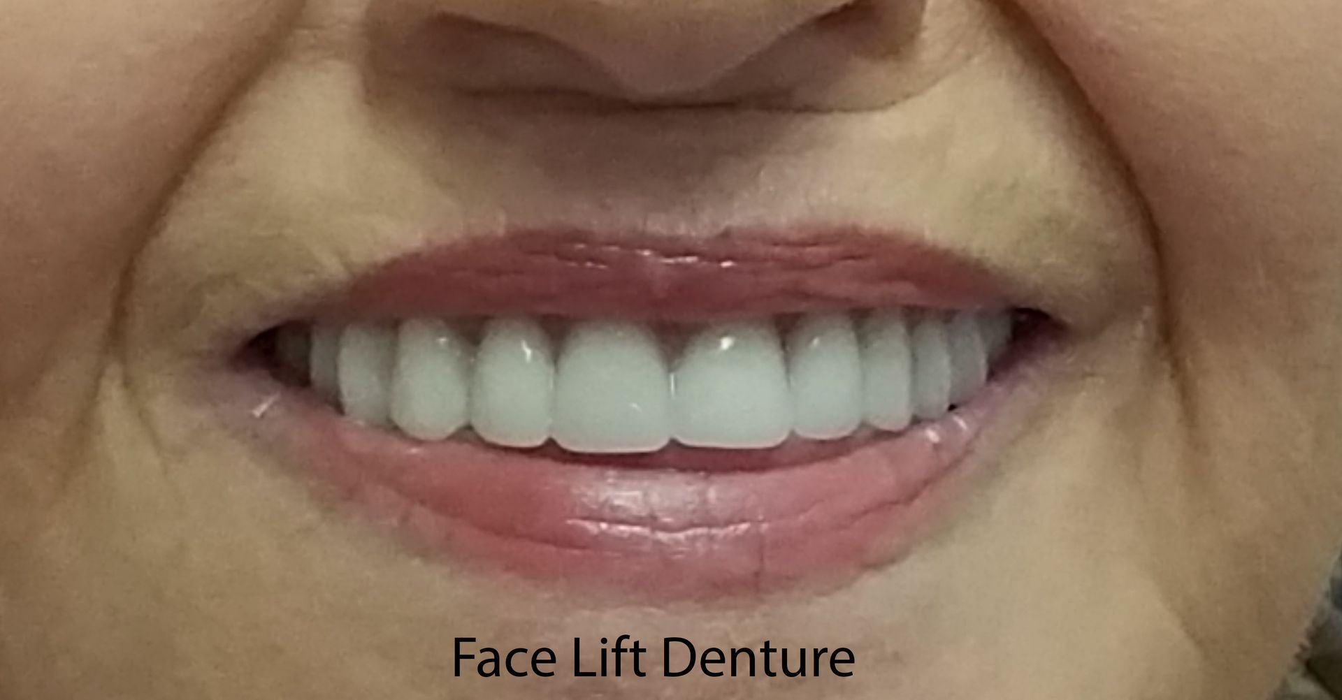 Face Lift Denture After — The Villages, FL — Central Florida Dental