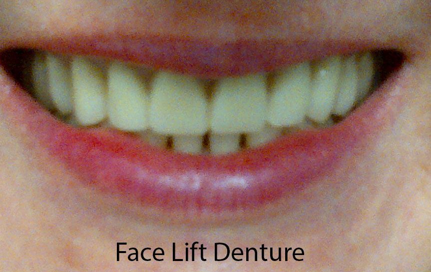 Face Lift Denture Before — The Villages, FL — Central Florida Dental