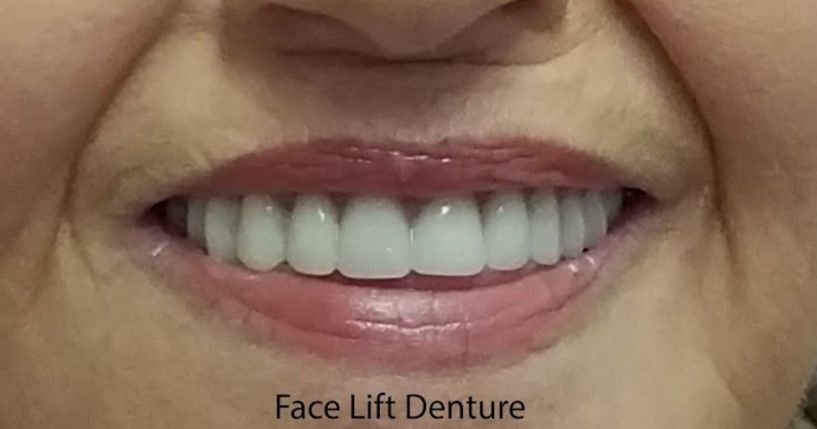 Face Lift Denture — The Villages, FL — Central Florida Dental
