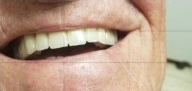 Fixed Permanent Porcelain Bridge After — The Villages, FL — Central Florida Dental