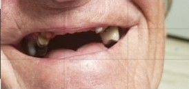 Fixed Permanent Porcelain Bridge Before — The Villages, FL — Central Florida Dental