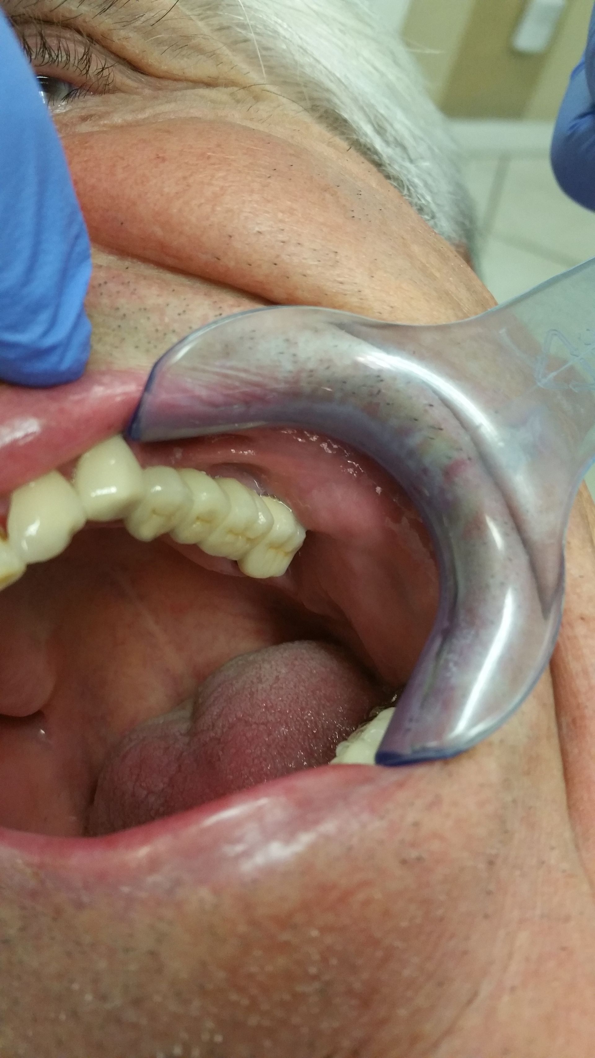 Implant Afer— The Villages, FL — Central Florida Dental
