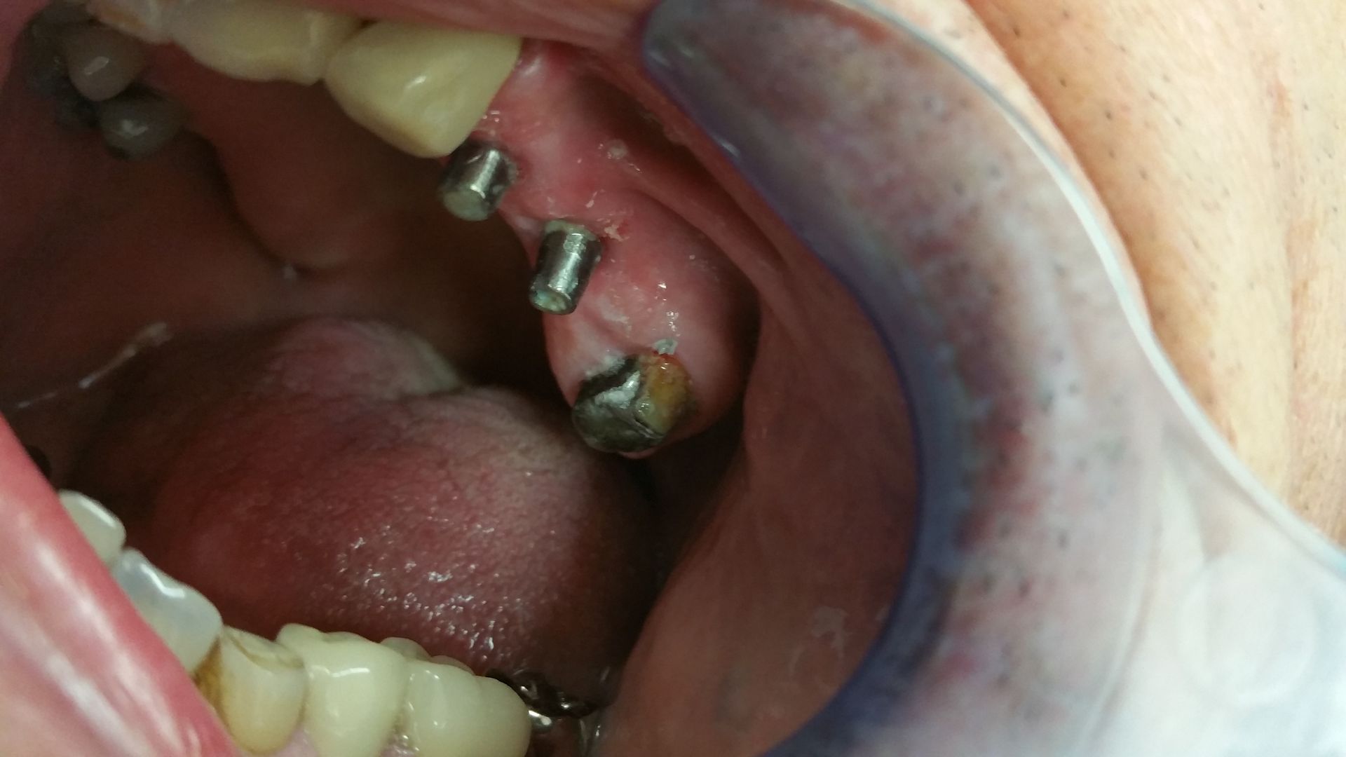 Implant Before — The Villages, FL — Central Florida Dental