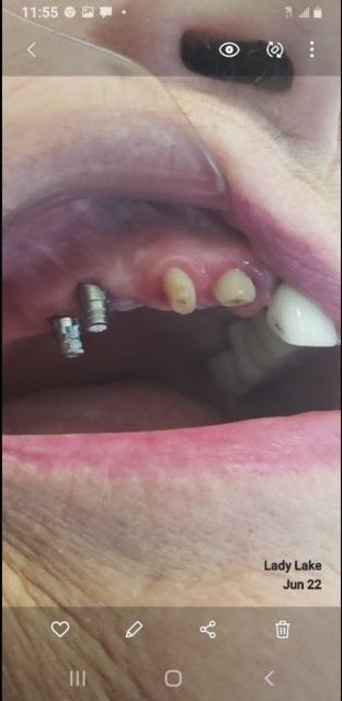 Before Permanent Fixed Implant Support Bridge  — The Villages, FL — Central Florida Dental