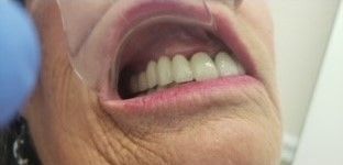 After Permanent Fixed Implant Support Bridge  — The Villages, FL — Central Florida Dental