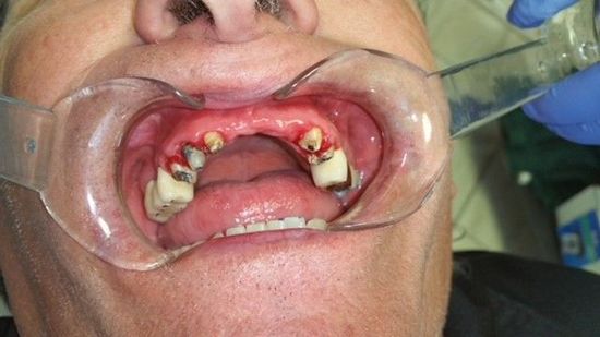 Before Fixed Permanent Porcelain Bridge— The Villages, FL — Central Florida Dental