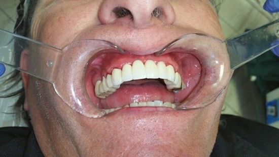 After Fixed Permanent Porcelain Bridge— The Villages, FL — Central Florida Dental