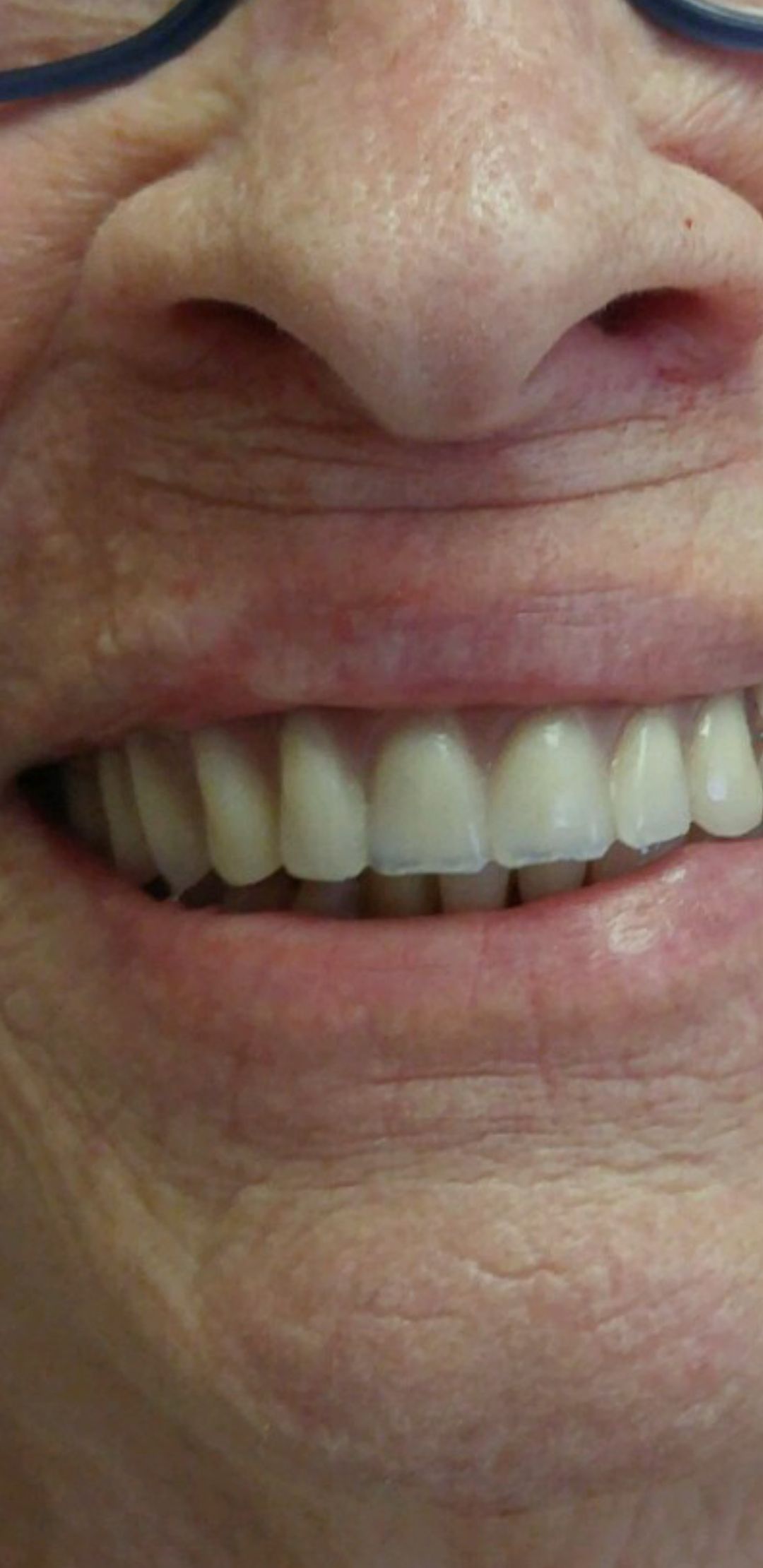 Aligned Teeth After Braces — The Villages, FL — Central Florida Dental