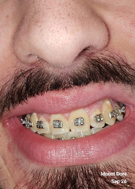 Aligned Teeth After Braces — The Villages, FL — Central Florida Dental