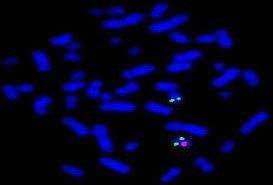 sindrome di Prader-Willi