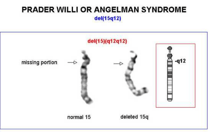 sindrome di Prader-Willi