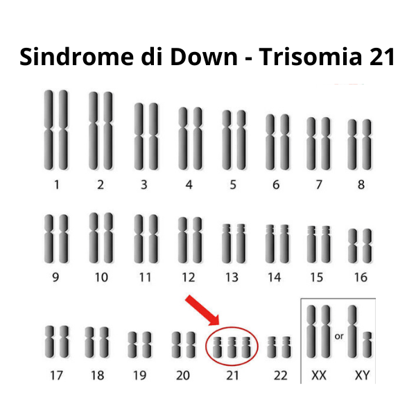 sindrome di down