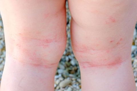 Bad skin, itching and eczema can be caused by hard water