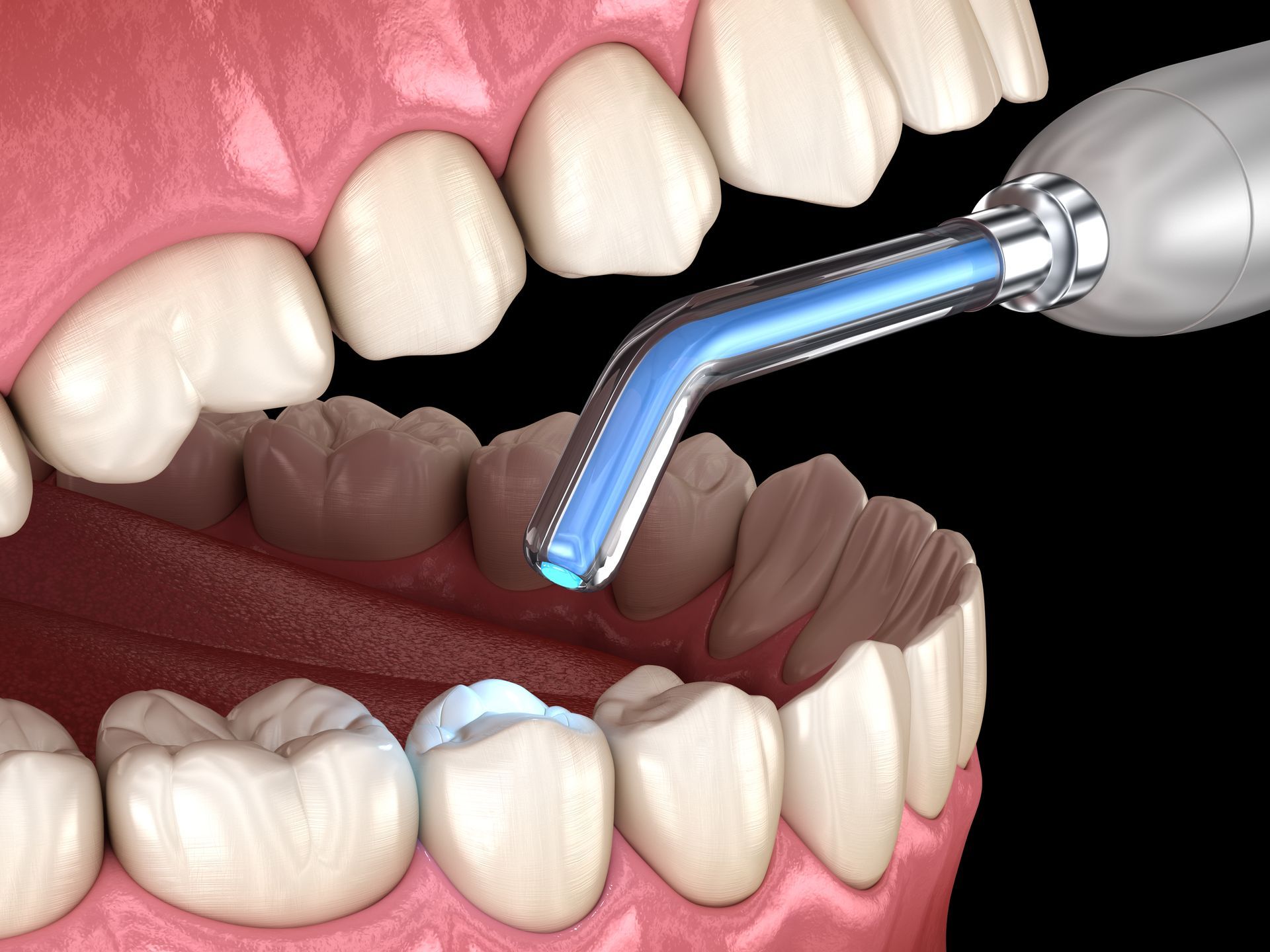 Dental Fillings — Hornsby, NSW — Smile Health Dental Care