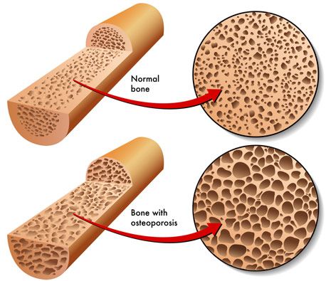 An illustration of normal bone and bone with osteoporosis