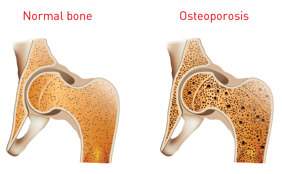 A diagram of a normal bone and an osteoporosis bone