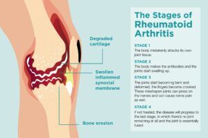 A diagram of the stages of rheumatoid arthritis.