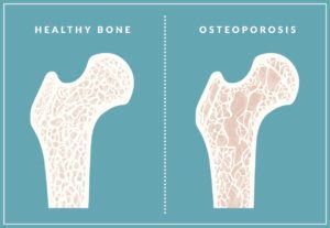 A healthy bone and an osteoporosis bone are shown on a blue background.