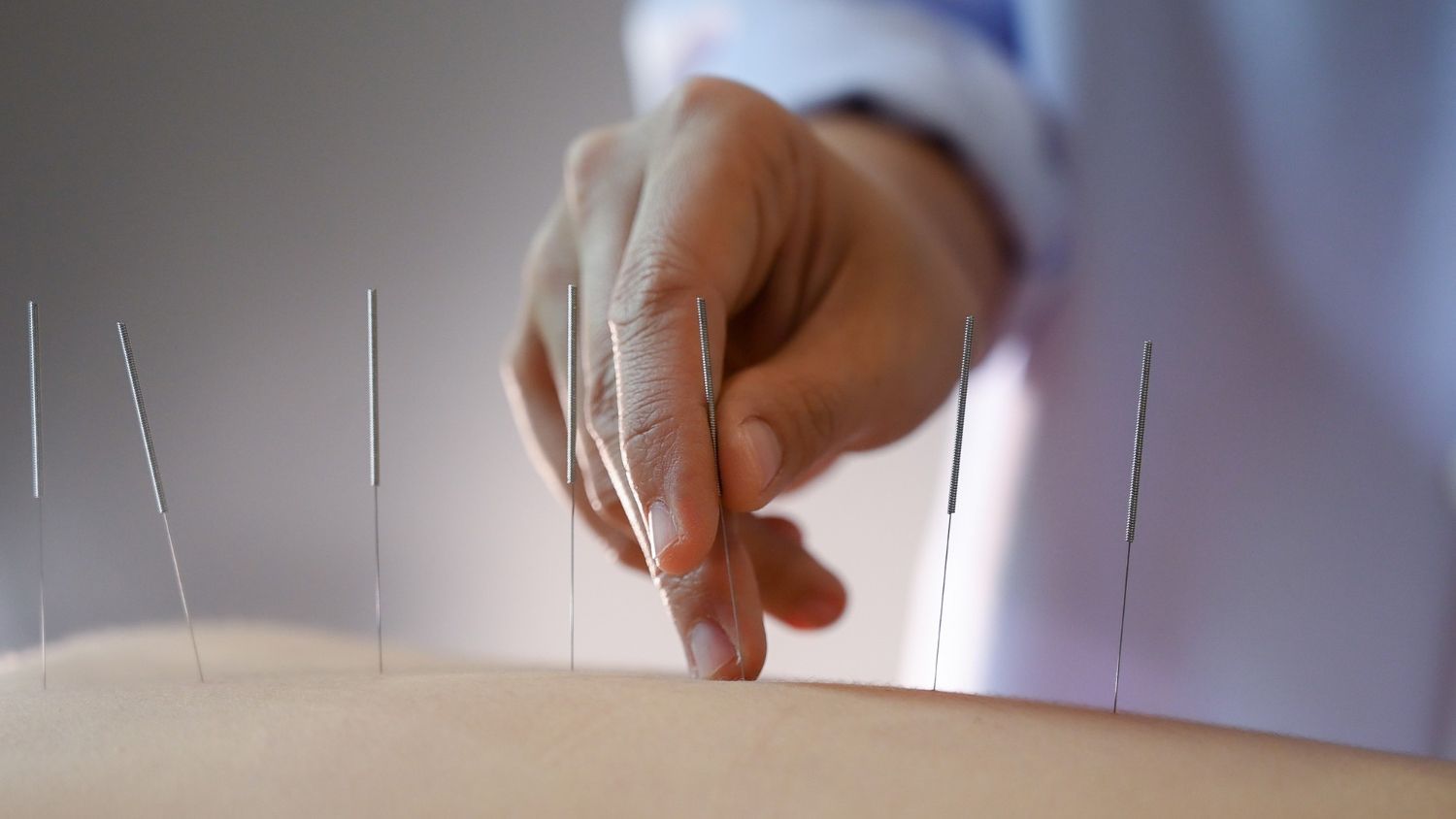 A person is getting acupuncture on their back.