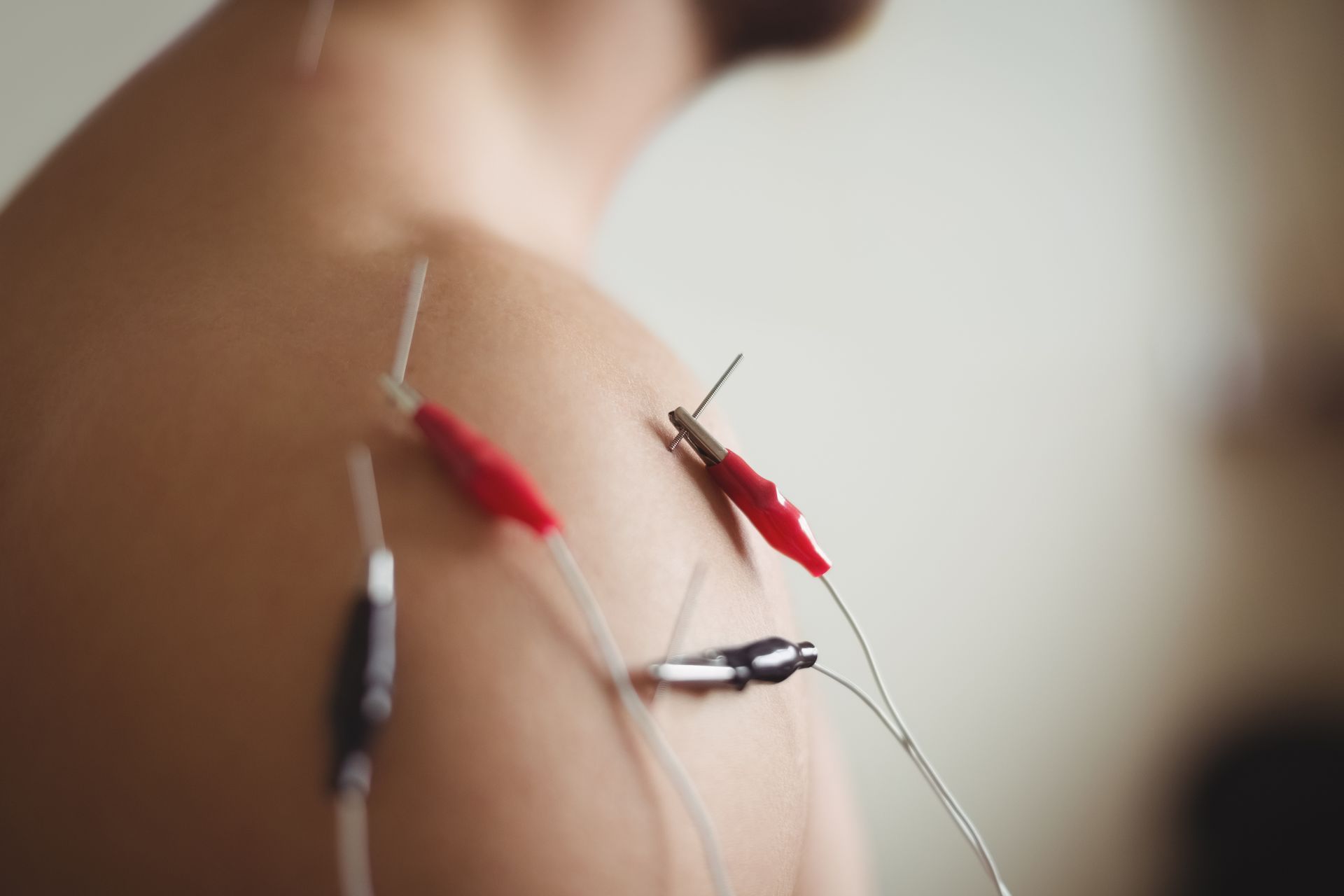 Person's back with acupuncture needles attached to red and black alligator clips, likely for electroacupuncture therapy.